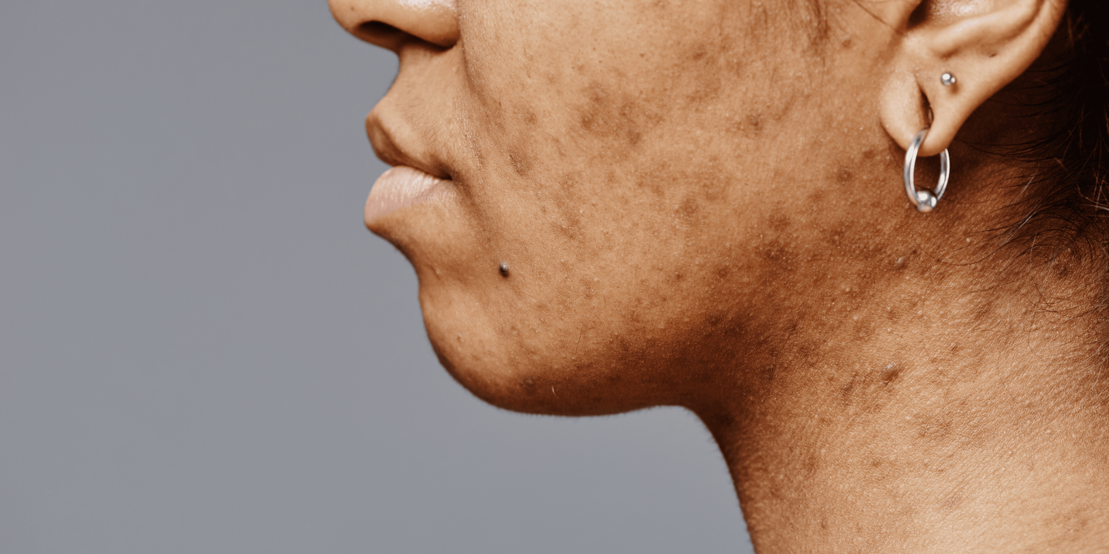 Comment Éliminer les Taches sur les Peaux Noires : Découvrez la Solution Efficace - Saba beauté