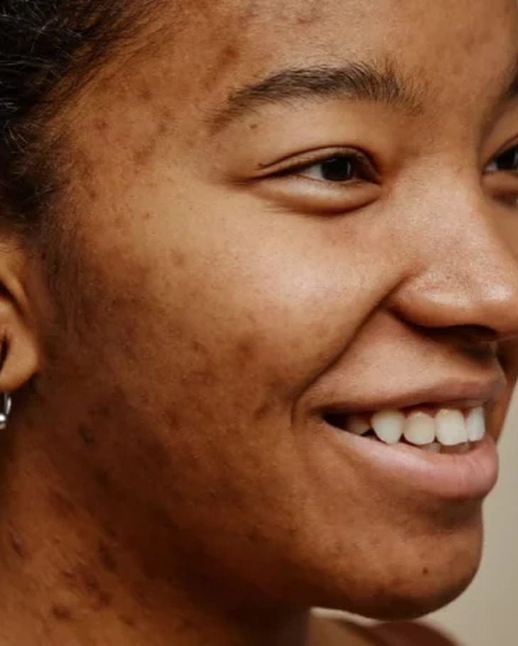 SOPK et cosmétiques : Pourquoi il est urgent de repenser sa routine beauté